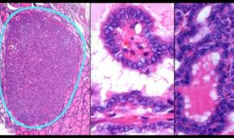 السير هاربال قال إنه أكثر تفاؤلاً من أي وقت مضى بشأن هزيمة السرطان (دويتشه فيلله)