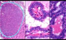 السير هاربال قال إنه أكثر تفاؤلاً من أي وقت مضى بشأن هزيمة السرطان (دويتشه فيلله)