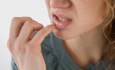 ‫كيف تتجنب الإصابة بقرحة الفم‬؟