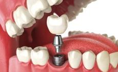 كل ما يجب أن تعرفه عن عملية زراعة الأسنان