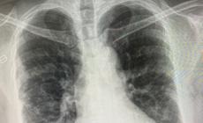 طبيب إيطالي: حالات تليف رئوي لدى بعض المتعافين من كورونا