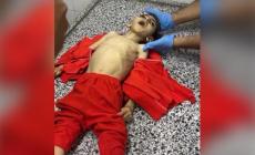 استشهاد طفل في غزة نتيجة سوء التغذية وسط تفاقم الأزمة الإنسانية