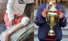 من ملاعب الحلم إلى سرير المعاناة.. مهند التلمس يواجه شللًا يهدد مستقبله