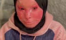 شهد العفيفي… طفولة شوهها المرض وقسوة الحصار