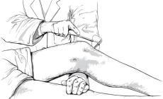 شد عضلي - صورة توضيحية 