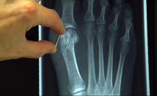 برغي لعلاج كسور العظم 