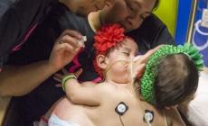 التوأم قبل لعملية