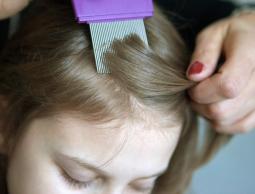 زيت السليكون يقضي على القمل