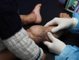 أطباء دوليون: جروح المدنيين في غزة الأسوأ على الإطلاق