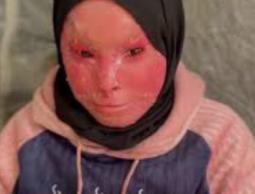 شهد العفيفي… طفولة شوهها المرض وقسوة الحصار