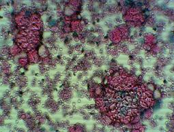 خلايا سرطانية 