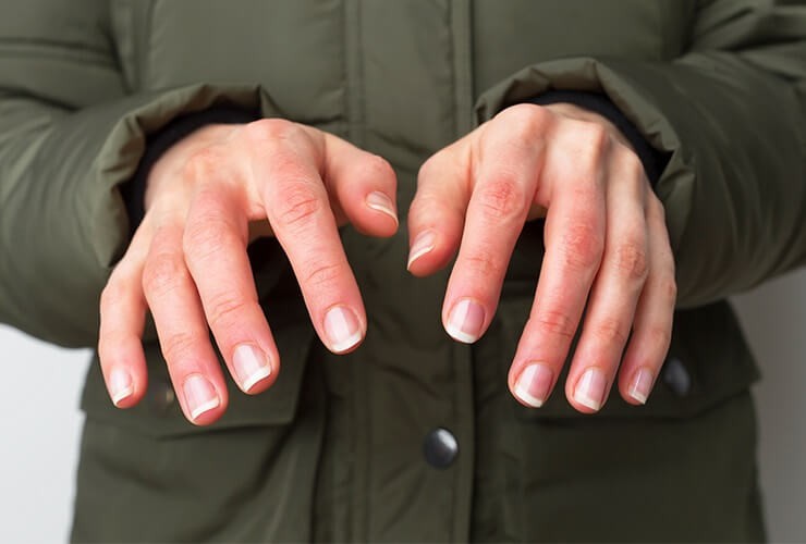 ما هي عضة الصقيع وطرق الوقاية منها؟