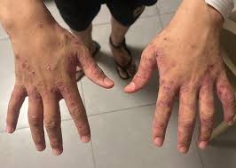 التعذيب بالجرب: سياسة الاعتقال الجديدة التي منعت إياد من احتضان أمه