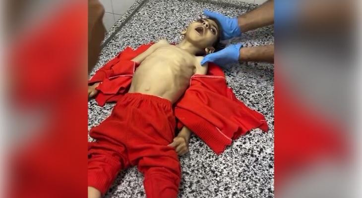 استشهاد طفل في غزة نتيجة سوء التغذية وسط تفاقم الأزمة الإنسانية