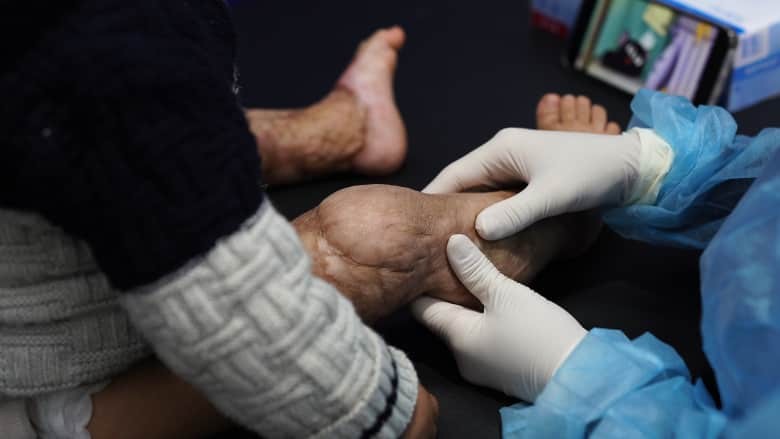 أطباء دوليون: جروح المدنيين في غزة الأسوأ على الإطلاق