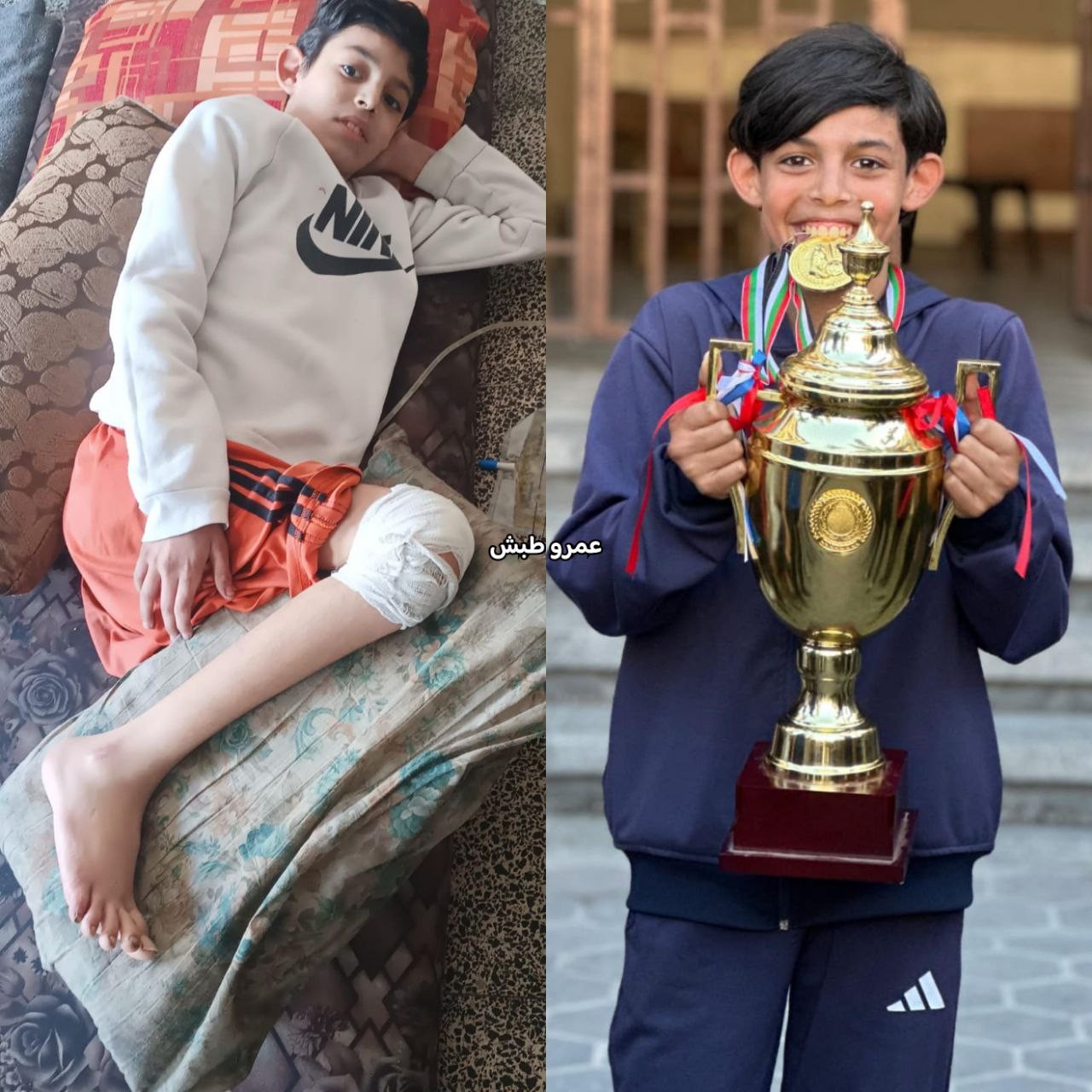 من ملاعب الحلم إلى سرير المعاناة.. مهند التلمس يواجه شللًا يهدد مستقبله