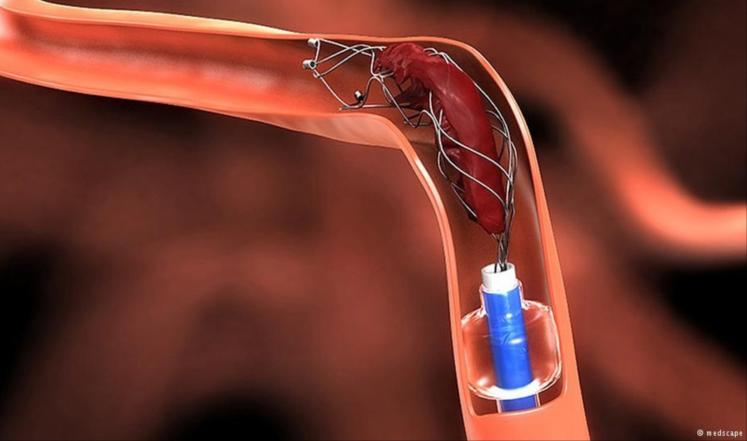 تقنية "اصطياد الجلطة" تعتمد على استئصال التخثر الدموي باستخدام قسطرة متناهية الصغر 