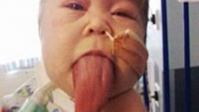 طفلة بريطانية لا يتوقف لسانها عن النمو